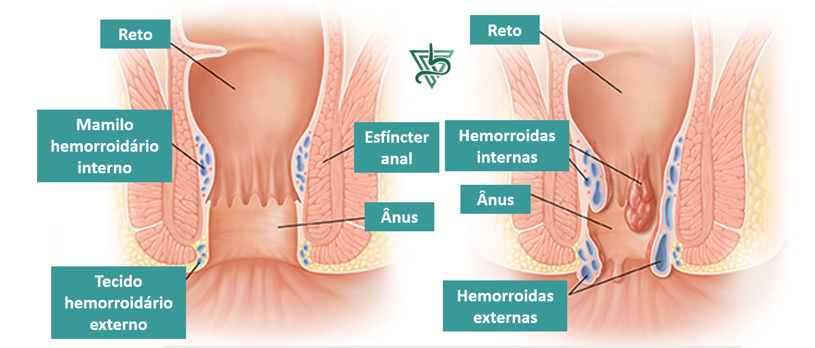 Anatomia Hemorroidas