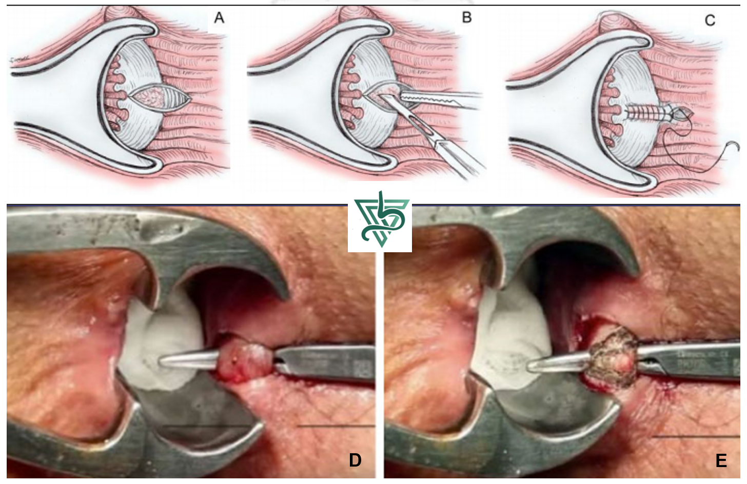 esfincterotomia lateral