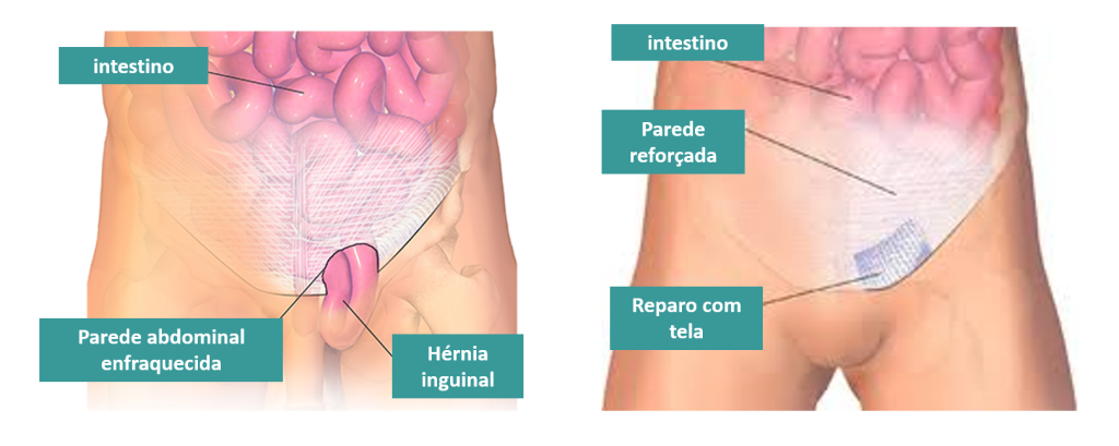 Hérnia inguinal - o que você precisa saber - Fabio Israel