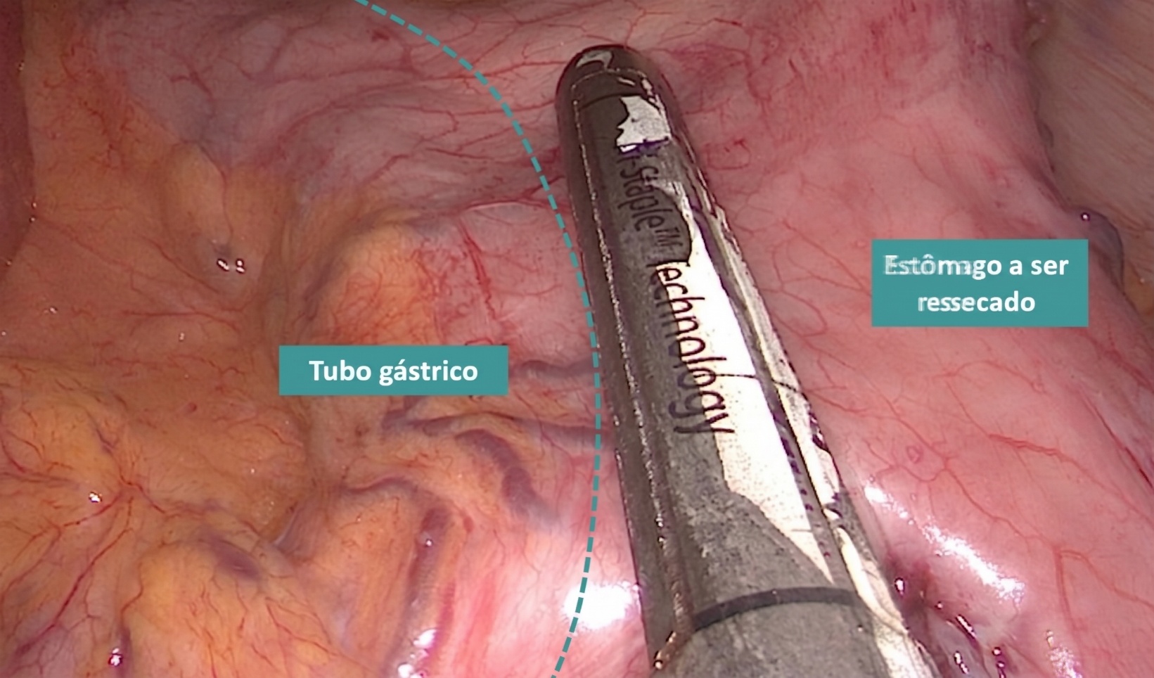 Imagem intraoperatória da gastrectomia vertical