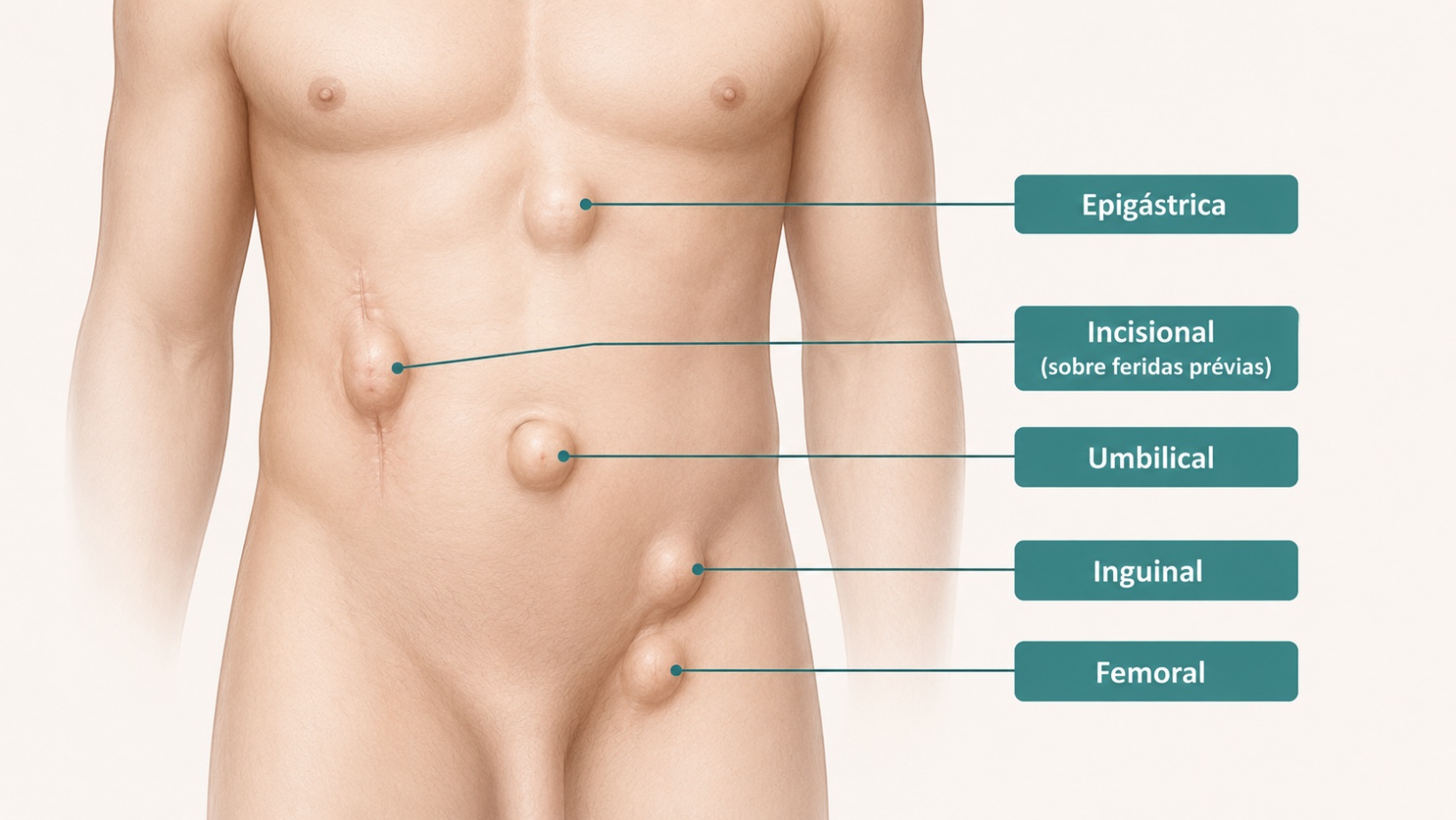 Tipos e localizações das hérnias da parede abdominal