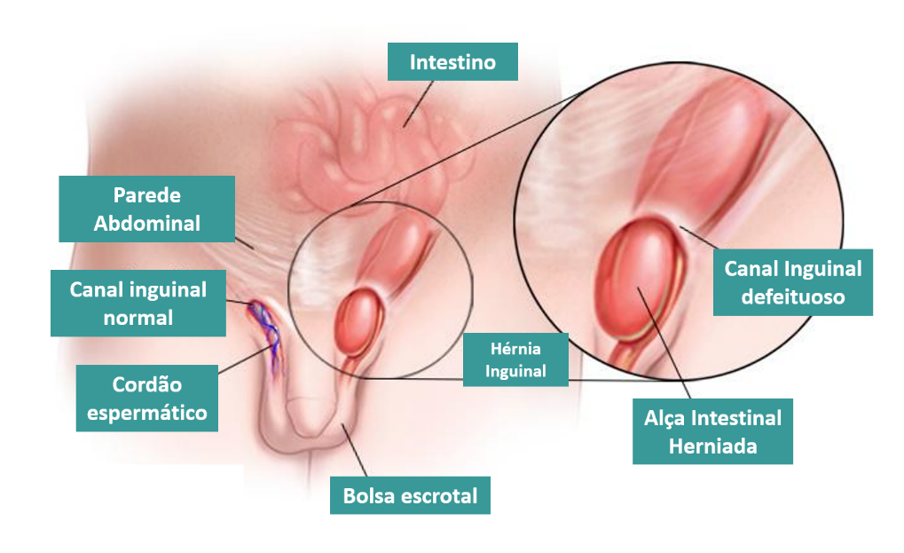 Anatomia da hérnia inguinal