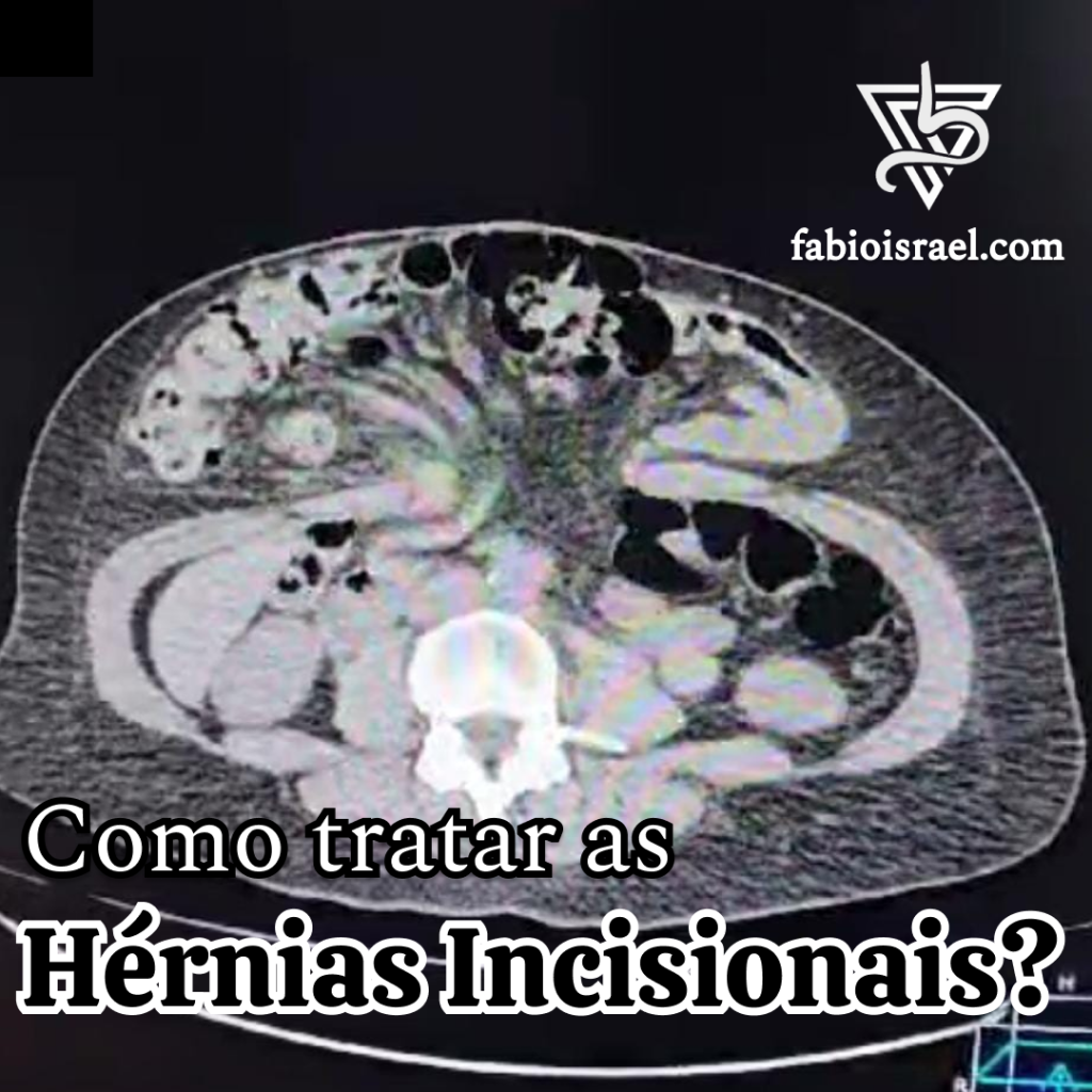 Hérnia incisional - capa